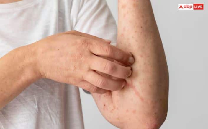 ਚਮੜੀ 'ਤੇ ਖੁਜਲੀ - ਗੁਰਦੇ ਸਰੀਰ ਵਿੱਚੋਂ ਜ਼ਹਿਰੀਲੇ ਪਦਾਰਥਾਂ ਨੂੰ ਬਾਹਰ ਕੱਢਣ ਦਾ ਕੰਮ ਕਰਦੇ ਹਨ ਪਰ ਜੇਕਰ ਗੁਰਦੇ ਸਹੀ ਢੰਗ ਨਾਲ ਕੰਮ ਨਹੀਂ ਕਰਦੇ, ਤਾਂ ਇਸ ਨਾਲ ਚਮੜੀ 'ਤੇ ਖੁਜਲੀ, ਜਲਣ ਅਤੇ ਖੁਸ਼ਕੀ ਹੋ ਜਾਂਦੀ ਹੈ।