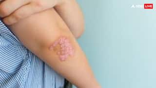 क्या होता है फंगल इंफेक्शन, जिस पर WHO की पहली रिपोर्ट ने बढ़ा दी टेंशन