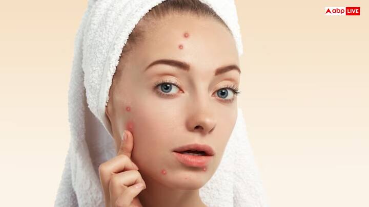 पिंपल्स करे कम - दही में नैचुरल एंटी-बैक्टीरियल और एंटी-फंगल गुण होते हैं, जो स्किन को बैक्टीरिया से बचाते हैं और पिंपल्स कम करते हैं.
