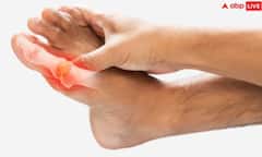 યુરિક એસિડ વધવા પર શરીરમાં જોવા મળેે છે આ લક્ષણો, કરો આ ઉપાય