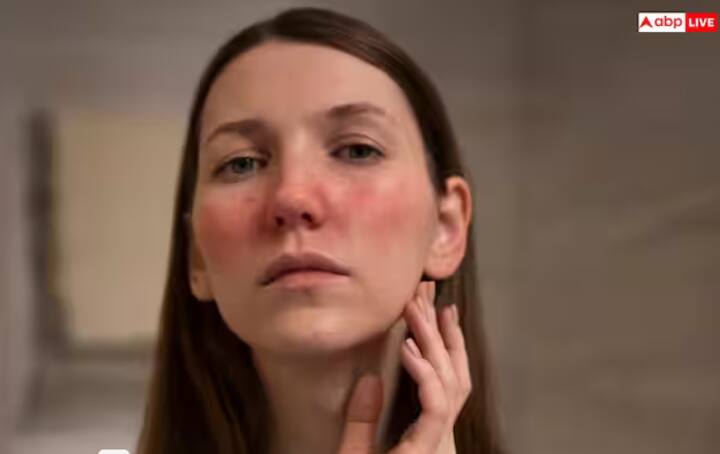 ਚਮੜੀ ਦੀ ਸੁੰਦਰਤਾ ਵਧਾਉਣ ਲਈ, ਸਾਡੇ ਵਿੱਚੋਂ ਬਹੁਤ ਸਾਰੇ ਲੋਕ ਆਪਣੇ ਚਿਹਰੇ 'ਤੇ ਨਿੰਬੂ ਲਗਾਉਂਦੇ ਹਨ। ਨਿੰਬੂ ਵਿੱਚ ਵਿਟਾਮਿਨ ਸੀ ਅਤੇ ਐਂਟੀਆਕਸੀਡੈਂਟ ਹੁੰਦੇ ਹਨ, ਜੋ ਚਮੜੀ ਦੇ ਰੰਗ ਨੂੰ ਸੁਧਾਰਨ, ਦਾਗ-ਧੱਬਿਆਂ ਨੂੰ ਦੂਰ ਕਰਨ ਅਤੇ ਆਇਲੀ ਸਕਿਨ ਨੂੰ ਕੰਟਰੋਲ ਕਰਨ ਵਿੱਚ ਅਸਰਦਾਰ ਹੈ, ਪਰ ਇਹ ਕੁਝ ਲੋਕਾਂ ਨੂੰ ਨੁਕਸਾਨ ਵੀ ਪਹੁੰਚਾ ਸਕਦਾ ਹੈ। ਆਓ ਜਾਣਦੇ ਹਾਂ ਚਿਹਰੇ 'ਤੇ ਨਿੰਬੂ ਲਗਾਉਣ ਦੇ ਕੀ ਨੁਕਸਾਨ ਹਨ? ਚਮੜੀ 'ਤੇ ਜਲਣ ਹੋ ਸਕਦੀ ਹੈ - ਨਿੰਬੂ ਵਿੱਚ ਸਿਟਰਿਕ ਐਸਿਡ ਹੁੰਦਾ ਹੈ, ਜੋ ਚਿਹਰੇ ਦੀ ਸੈਂਸੇਟਿਵ ਸਕਿਨ ਨੂੰ ਨੁਕਸਾਨ ਪਹੁੰਚਾ ਸਕਦਾ ਹੈ। ਇਸ ਨਾਲ ਚਮੜੀ 'ਤੇ ਜਲਣ, ਖੁਜਲੀ, ਜਲਣ ਜਾਂ ਲਾਲ ਧੱਫੜ ਪੈ ਸਕਦੇ ਹਨ। ਇਸ ਲਈ, ਜੇਕਰ ਤੁਹਾਡੀ ਚਮੜੀ ਸੈਂਸੇਟਿਵ ਹੈ, ਤਾਂ ਇਸਦੀ ਵਰਤੋਂ ਨਾ ਕਰੋ।