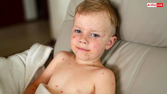 Measles in USA: इस खतरनाक बीमारी की चपेट में आया अमेरिका, टेक्सास में 700 से ज्यादा बीमार