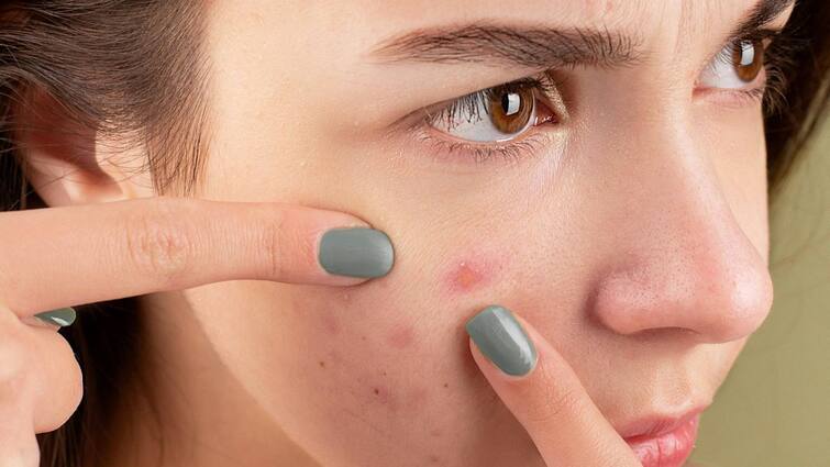 skin problems reasons behind acne know some tips to prevent and reduce this Acne Problem: কোন কোন কারণে ত্বকে দেখা দেয় ব্রন, সমস্যা বেড়ে যায় কখন, কীভাবে সতর্ক থাকবেন?
