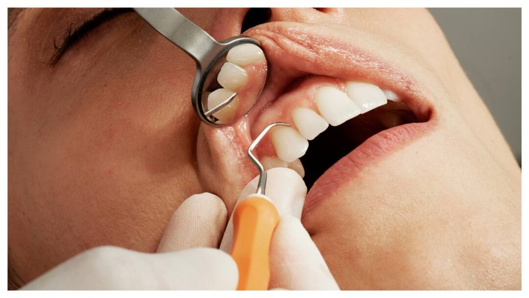 UP Ghaziabad Wisdom Tooth Removal Surgery Goes Wrong, Woman Vomits Pieces Of Flesh Wisdom Tooth Removal Surgery Goes Wrong, Woman Vomits Pieces Of Flesh