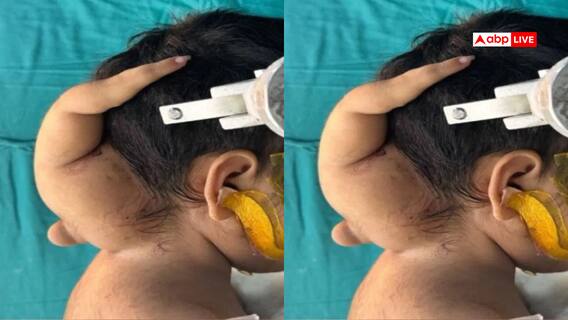 सिर-गर्दन पर थे अविकसित ‘जुड़वां बच्चे’ के अंग, AIIMS के डॉक्टर्स ने 3 साल की बच्ची को दी नई जिदंगी