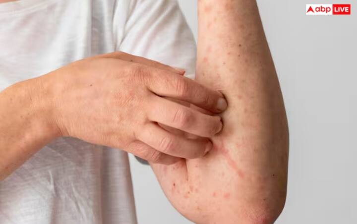 ਸਕਿਨ 'ਤੇ ਖੁਜਲੀ ਅਤੇ ਰੈਸ਼ਿਸ਼- ਲੀਵਰ ਸਿਰੋਸਿਸ ਦੇ ਗੰਭੀਰ ਮਾਮਲਿਆਂ ਵਿੱਚ ਲੀਵਰ ਜ਼ਹਿਰੀਲੇ ਪਦਾਰਥਾਂ ਨੂੰ ਹਟਾਉਣ ਦੇ ਯੋਗ ਨਹੀਂ ਹੁੰਦਾ, ਜਿਸ ਕਾਰਨ ਖੁਜਲੀ ਅਤੇ ਧੱਫੜ ਹੋ ਸਕਦੇ ਹਨ।