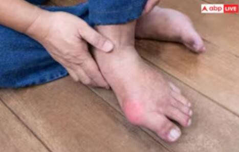 આલ્કોહોલ, ખાસ કરીને બીયર અને ડિસ્ટીલ્ડ લિકર યુરિક એસિડનું સ્તર વધારી શકે છે. તેથી, તેના વપરાશને મર્યાદિત અથવા બંધ કરવું ફાયદાકારક છે.