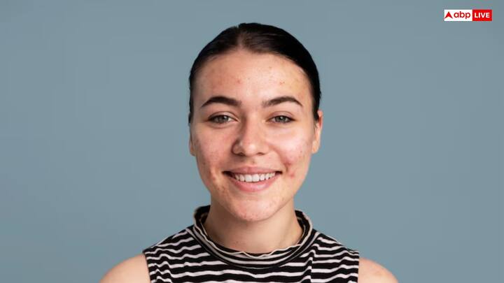 पिंपल्स और एक्ने करे कम - नीम के पानी में मौजूद एंटी-बैक्टीरियल तत्व स्किन से बैक्टीरिया हटाते हैं जो मुंहासों का कारण बनते हैं. रोजाना इसका उपयोग करने से पिंपल्स की संख्या कम होती है और स्किन साफ दिखने लगती है.