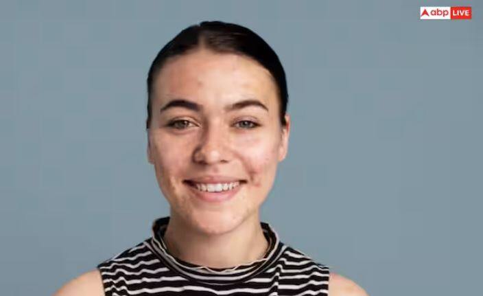 ਨਿੰਮ ਦੇ ਪਾਣੀ ਵਿੱਚ ਮੌਜੂਦ ਐਂਟੀ-ਬੈਕਟੀਰੀਅਲ ਤੱਤ ਚਮੜੀ ਤੋਂ ਬੈਕਟੀਰੀਆ ਨੂੰ ਹਟਾਉਂਦੇ ਹਨ ਜੋ ਮੁਹਾਸੇ ਪੈਦਾ ਕਰਦੇ ਹਨ। ਇਸ ਦੀ ਰੋਜ਼ਾਨਾ ਵਰਤੋਂ ਕਰਨ ਨਾਲ ਮੁਹਾਸੇ ਘੱਟ ਜਾਂਦੇ ਹਨ ਤੇ ਚਮੜੀ ਸਾਫ਼ ਦਿਖਾਈ ਦੇਣ ਲੱਗਦੀ ਹੈ।