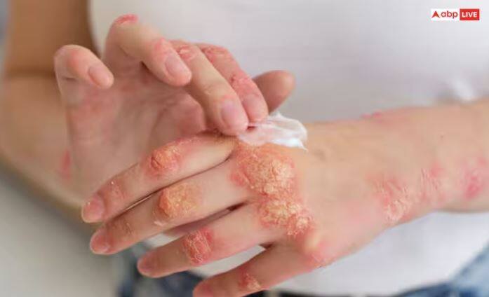 ਜੇ ਤੁਹਾਡੀ ਚਮੜੀ 'ਤੇ ਖੁਜਲੀ, ਲਾਲ ਧੱਫੜ ਹਨ ਤਾਂ ਨਿੰਮ ਦਾ ਪਾਣੀ ਬਹੁਤ ਫਾਇਦੇਮੰਦ ਹੈ। ਇਹ ਇਨਫੈਕਸ਼ਨ ਨੂੰ ਫੈਲਣ ਤੋਂ ਰੋਕਦਾ ਹੈ ਤੇ ਜਲਣ ਤੋਂ ਰਾਹਤ ਪ੍ਰਦਾਨ ਕਰਦਾ ਹੈ।