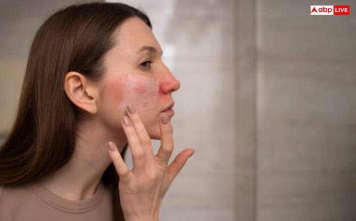 ਗਰਮੀਆਂ ਵਿੱਚ ਮਿਲਣ ਵਾਲਾ ਫਲ ਅੰਬ, ਜਿਸ ਨੂੰ ਫਲਾਂ ਦਾ ਰਾਜਾ ਕਿਹਾ ਜਾਂਦਾ ਹੈ ਅਤੇ ਲਗਭਗ ਹਰ ਕਿਸੇ ਨੂੰ ਇਹ ਪਸੰਦ ਹੁੰਦਾ ਹੈ। ਪਰ ਕੀ ਤੁਸੀਂ ਜਾਣਦੇ ਹੋ ਕਿ ਅੰਬ ਖਾਣਾ ਕੁਝ ਲੋਕਾਂ ਲਈ ਨੁਕਸਾਨਦੇਹ ਹੋ ਸਕਦਾ ਹੈ? ਹਾਂ, ਕੁਝ ਖਾਸ ਸਥਿਤੀਆਂ ਵਿੱਚ ਅੰਬ ਦਾ ਸੇਵਨ ਸਿਹਤ ਲਈ ਖ਼ਤਰਨਾਕ ਹੋ ਸਕਦਾ ਹੈ। ਆਓ ਜਾਣਦੇ ਹਾਂ ਅੰਬ ਖਾਣ ਦੇ ਕੀ ਨੁਕਸਾਨ ਹਨ? ਸਕਿਨ ਐਲਰਜੀ - ਕੁਝ ਲੋਕਾਂ ਨੂੰ ਅੰਬ ਤੋਂ ਐਲਰਜੀ ਹੋ ਸਕਦੀ ਹੈ। ਅੰਬ ਦੇ ਛਿੱਲਣ ਵਿੱਚ ਯੂਰੂਸ਼ੀਓਲ ਨਾਮਕ ਇੱਕ ਰਸਾਇਣ ਹੁੰਦਾ ਹੈ, ਜਿਸ ਨਾਲ ਚਮੜੀ 'ਤੇ ਧੱਫੜ ਅਤੇ ਛਾਲੇ ਹੋ ਸਕਦੇ ਹਨ।