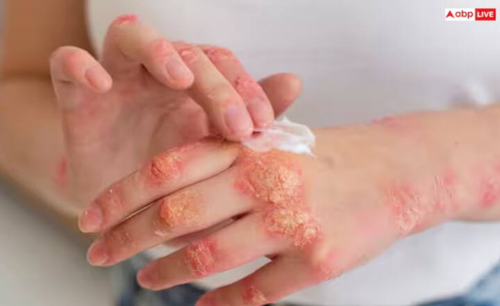 ਫੰਗਲ ਇਨਫੈਕਸ਼ਨ ਤੋਂ ਛੁਟਕਾਰਾ - ਜੇਕਰ ਤੁਹਾਡੀ ਚਮੜੀ 'ਤੇ ਖੁਜਲੀ, ਲਾਲ ਧੱਫੜ ਜਾਂ ਧੱਫੜ ਹਨ, ਤਾਂ ਨਿੰਮ ਦਾ ਪਾਣੀ ਬਹੁਤ ਫਾਇਦੇਮੰਦ ਹੈ। ਇਹ ਇਨਫੈਕਸ਼ਨ ਨੂੰ ਫੈਲਣ ਤੋਂ ਰੋਕਦਾ ਹੈ ਅਤੇ ਜਲਣ ਤੋਂ ਰਾਹਤ ਪ੍ਰਦਾਨ ਕਰਦਾ ਹੈ।