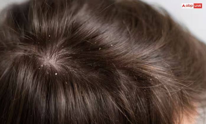 ਨਿੰਮ ਦਾ ਪਾਣੀ ਸਿਰ ਦੀ ਚਮੜੀ 'ਤੇ ਵੀ ਲਗਾਇਆ ਜਾ ਸਕਦਾ ਹੈ। ਇਹ ਡੈਂਡਰਫ ਨੂੰ ਘਟਾਉਂਦਾ ਹੈ ਤੇ ਵਾਲਾਂ ਦੇ ਝੜਨ ਦੀ ਸਮੱਸਿਆ ਤੋਂ ਰਾਹਤ ਦਿੰਦਾ ਹੈ।