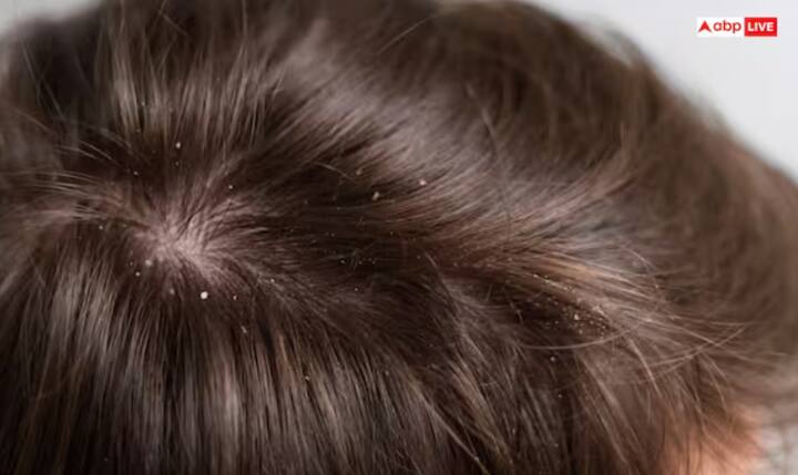 ਡੈਂਡਰਫ ਤੋਂ ਰਾਹਤ - ਨਿੰਮ ਦਾ ਪਾਣੀ ਸਕੈਲਪ 'ਤੇ ਵੀ ਲਗਾਇਆ ਜਾ ਸਕਦਾ ਹੈ। ਇਹ ਡੈਂਡਰਫ ਨੂੰ ਘਟਾਉਂਦਾ ਹੈ ਅਤੇ ਵਾਲਾਂ ਦੇ ਝੜਨ ਦੀ ਸਮੱਸਿਆ ਤੋਂ ਰਾਹਤ ਦਿੰਦਾ ਹੈ।