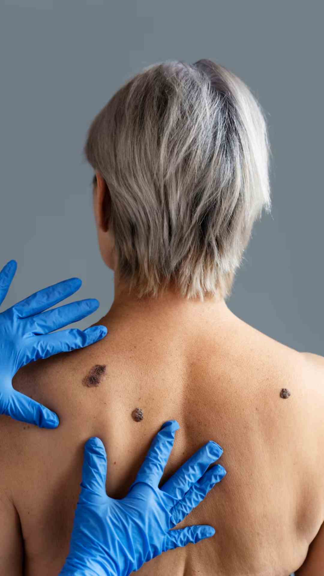 मस्से हटाने के लिए चूना लगाना कितना सही