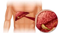 Prevent Liver Infection : లివర్ ఇన్​ఫెక్షన్లు రాకుండా తీసుకోవాల్సిన జాగ్రత్తలివే.. కాలేయం జాగ్రత్త బ్రో