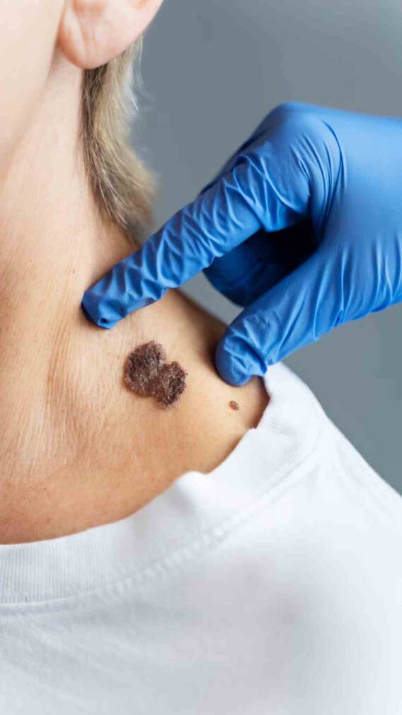 मस्से हटाने के लिए चूना लगाना कितना सही