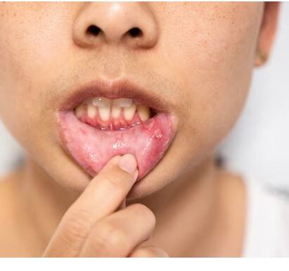 ਮੂੰਹ ਦੇ ਕੈਂਸਰ ਦੇ ਮੁੱਖ ਕਾਰਨ ਤੰਬਾਕੂ ਅਤੇ ਸ਼ਰਾਬ ਦਾ ਸੇਵਨ, ਬਹੁਤ ਜ਼ਿਆਦਾ ਧੁੱਪ ’ਚ ਰਹਿਣਾ ਅਤੇ ਮਾੜੀ ਮੂੰਹ ਦੀ ਸਫਾਈ ਹਨ। ਜੇਕਰ ਕਿਸੇ ਵਿਅਕਤੀ ਦੇ ਮੂੰਹ ’ਚ ਅਕਸਰ ਫੋੜੇ ਹੁੰਦੇ ਹਨ ਜੋ ਠੀਕ ਨਹੀਂ ਹੁੰਦੇ, ਤਾਂ ਮੂੰਹ ਦੇ ਕੈਂਸਰ ਦਾ ਖ਼ਤਰਾ ਵੱਧ ਸਕਦਾ ਹੈ।