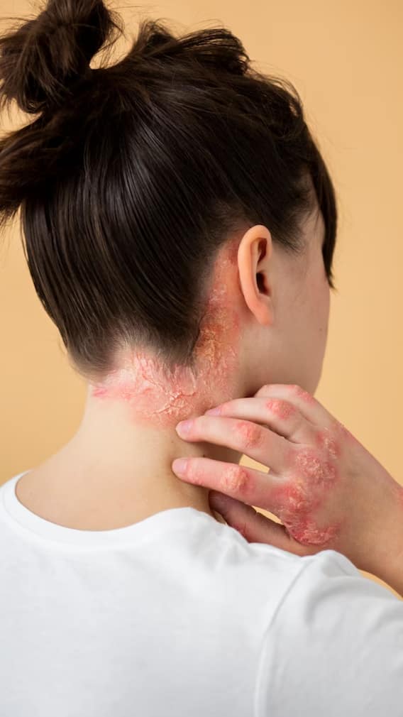 दाद-खुजली होने का क्या होता है सबसे बड़ा कारण