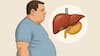 World Liver Day 2025 — Obesity Crisis In India And Its Impact On Liver Health