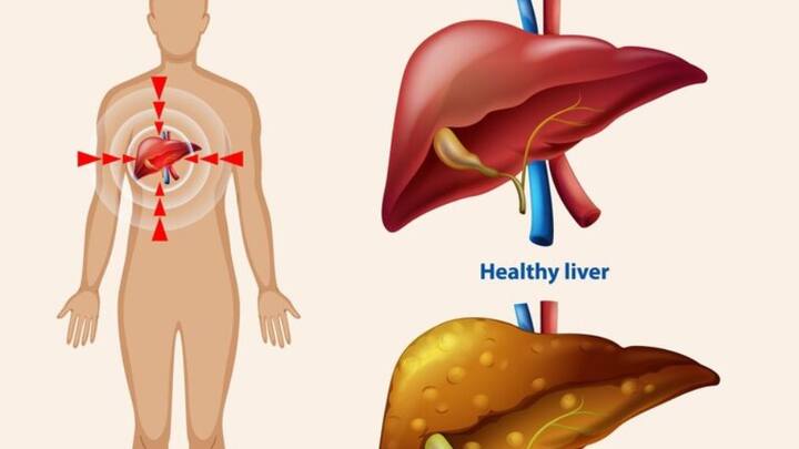 অস্বাস্থ্যকর খাবারের কারণে আমাদের লিভারের ভিতরে অজান্তেই বিষ প্রবেশ করছে। আর আজ ১৯ এপ্রিল এই সম্পর্কে মানুষকে সচেতন করতেই বিশ্বজুড়ে পালিত হয় বিশ্ব লিভার দিবস।