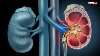 पथरी के मरीजों को खिलाई जाती है ये वाली दाल, फायदे जानकर हैरान रह जाएंगे आप