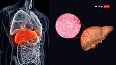 MAFLD — When Alcohol Is Not The Only Reason For Fatty Liver