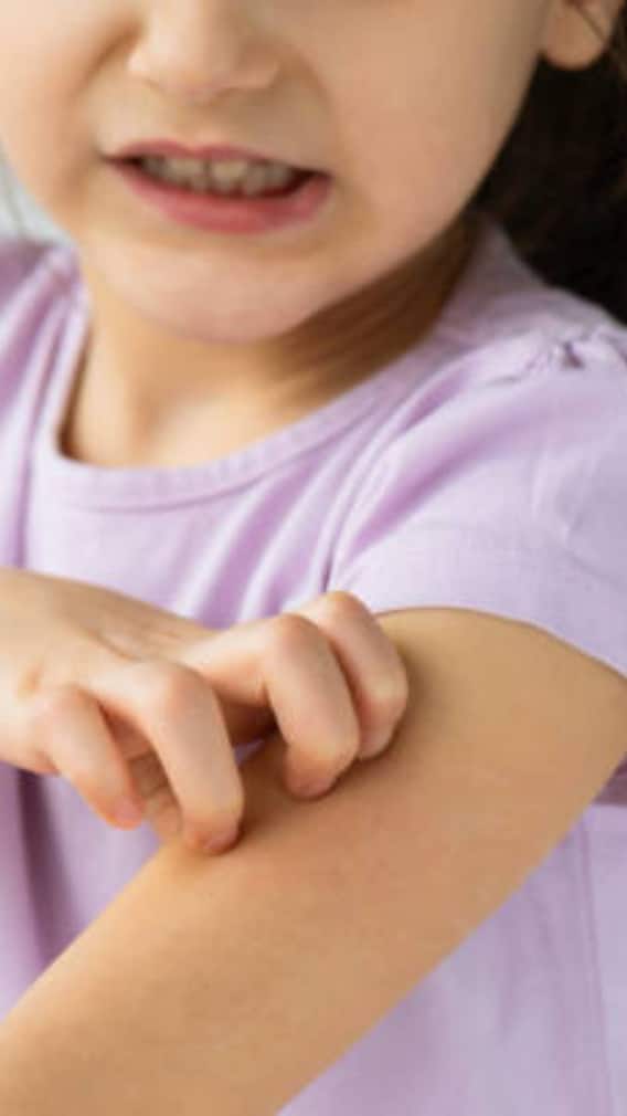 गर्मी में घमौरियों का ये है देसी उपाय