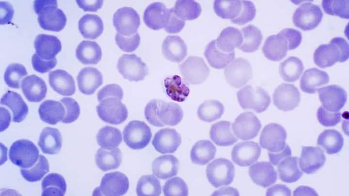 1. The Cause: Malaria is caused by the Plasmodium parasite, transmitted through mosquito bites, and often starts with fever that can lead to severe complications. (Image Source: Pinterest/owlcation)