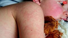 बच्चों को नहीं सताएंगी घमौरियां, गर्मी में रखें इन बातों का खास ध्यान