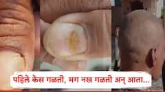 पहिले केस गळती, मग नख गळती अन् आता...; बुलढाण्यात पुन्हा एकदा भीतीचं वातावरण, नेमकं काय घडतंय?