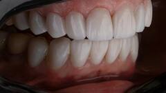 Teeth Cleaning : पिवळे दात चमकवायचेत? ही घरगुती पावडर तयार करा!