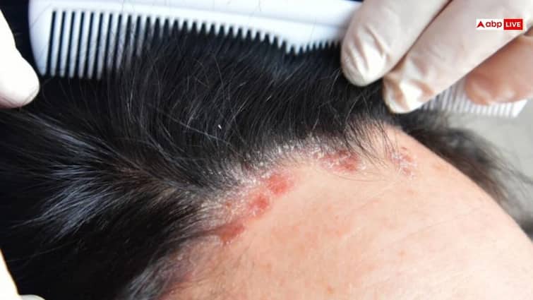 how to identify scalp psoriasis making mistake of considering dandruff Know the symptoms कहीं सोराइसिस को डैंड्रफ समझने की गलती तो नहीं कर रहे आप, जान लीजिए कैसे दिखते हैं लक्षण?