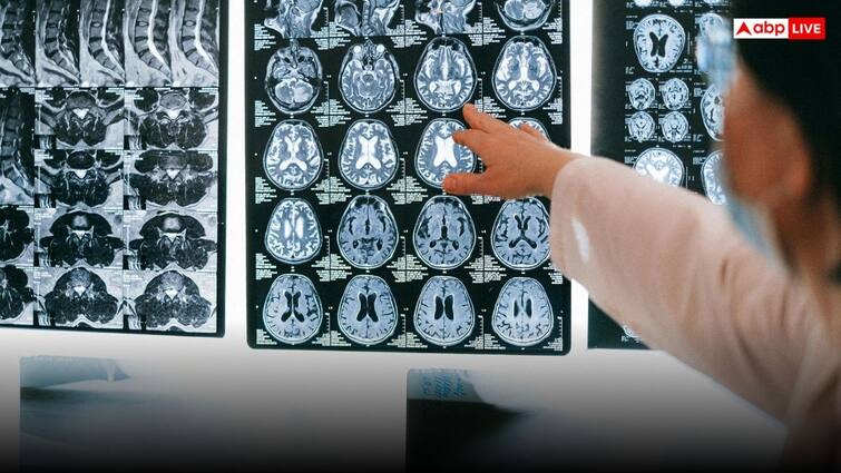 5 dangerous diseases that connected with human mind know its symptoms ये हैं दिमाग से जुड़ी पांच सबसे खतरनाक बीमारियां, ऐसे दिखते हैं लक्षण