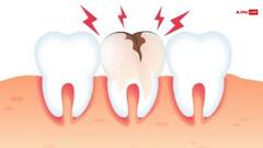 इन कारणों से दांतों में होने लगती है कैविटी की शिकायत, जानिए कैसे पाएं छुटकारा