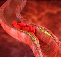 ਹਾਈ ਕੋਲੈਸਟਰੋਲ ਇੱਕ 'ਸਾਇਲੈਂਟ ਕਿਲਰ'...ਪਰ ਪੈਰ ਦੇਣ ਲੱਗ ਪੈਂਦੇ ਅਜਿਹੇ ਸੰਕੇਤ, ਨਾ ਕਰੋ ਨਜ਼ਰਅੰਦਾਜ਼