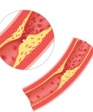 ਜੇ ਤੁਹਾਨੂੰ ਤੁਰਨ ਜਾਂ ਸੀੜ੍ਹੀਆਂ ਚੜ੍ਹਨ ਦੌਰਾਨ ਪਿੰਡਲੀਆਂ (ਕਾਫ ਮਾਸਪੇਸ਼ੀਆਂ) ਵਿੱਚ ਦਰਦ ਜਾਂ ਖਿਚਾਅ ਮਹਿਸੂਸ ਹੁੰਦਾ ਹੈ, ਤਾਂ ਇਹ ਪਰਿਫਿਰਲ ਆਰਟਰੀ ਡਿਜੀਜ਼ (PAD) ਦਾ ਇਸ਼ਾਰਾ ਹੋ ਸਕਦਾ ਹੈ। ਇਹ ਉਹ ਹਾਲਤ ਹੁੰਦੀ ਹੈ ਜਦੋਂ ਕੋਲੈਸਟਰੋਲ ਆਰਟਰੀਜ਼ ਵਿੱਚ ਜੰਮ ਜਾਂਦਾ ਹੈ ਅਤੇ ਖ਼ੂਨ ਦੇ ਪ੍ਰਭਾਹ ਵਿੱਚ ਰੁਕਾਵਟ ਪੈਦਾ ਕਰਦਾ ਹੈ।