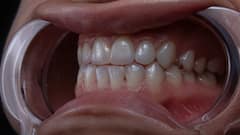 Can Gum Disease Harm Your Heart? New Study Links Oral Bacteria To Dangerous Heart Rhythm