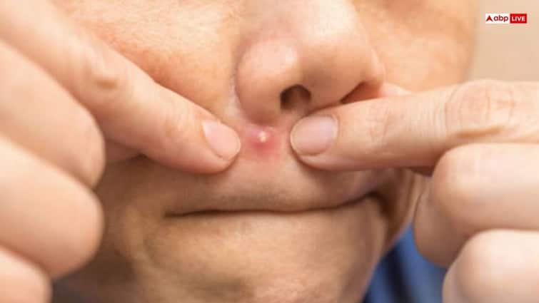 popping pimple on danger zone can damage brain triangle of death इस जगह की फुंसी फोड़ने से डैमेज हो सकता है आपका दिमाग, कहलाता है 'ट्रायंगल ऑफ डेथ'