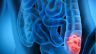 Colon Cancer: ਪੇਟ ਦਰਦ ਸਣੇ ਇਹ ਸਮੱਸਿਆ, ਇਸ ਘਾਤਕ ਬਿਮਾਰੀ ਦੀ ਸ਼ੁਰੂਆਤ? ਨਜ਼ਰਅੰਦਾਜ਼ ਕਰਨਾ ਮੌਤ ਨੂੰ ਬੁਲਾਵਾ; ਮਸ਼ਹੂਰ ਗਾਇਕਾ ਦੀ ਲਈ ਜਾਨ...