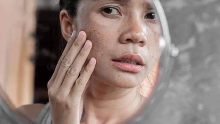 Increased Pigmentation: Hormonal changes can trigger melasma a form of hyperpigmentation that appears as dark patches, often on the cheeks, forehead, or upper lip. (Image Source: Pinterest/ demirirnoel1542)