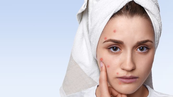 Acne Flare-Ups: Hormonal fluctuations, especially during puberty, menstruation, pregnancy, or menopause, can increase sebum production, leading to clogged pores and acne particularly along the jawline and chin. (Image Source: Canva)
