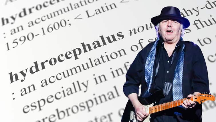 Singer Billy Joel Has A Rare Brain Disorder — All About Normal Pressure Hydrocephalus