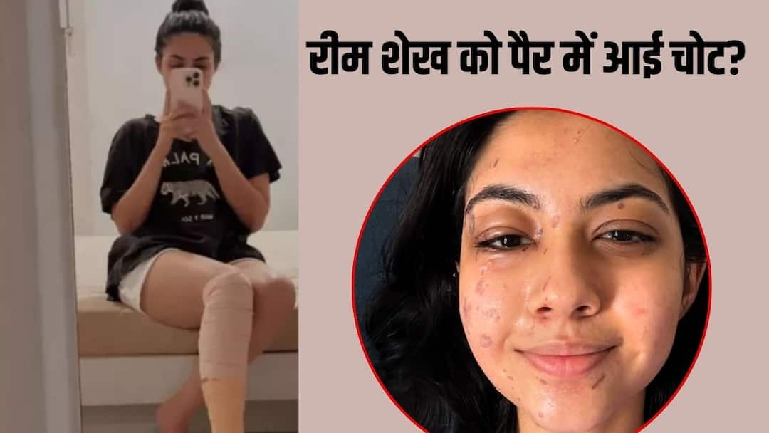 Reem Shaikh Leg severe pain on Laughter Chefs 2 Sets Shares health update after face burn पहले जला चेहरा, अब पैर में लगी चोट, लाफ्टर शेफ में एक्ट्रेस के साथ दो बार हुआ हादसा?