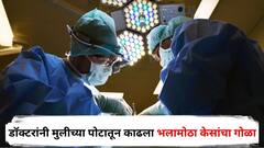 14 वर्षांच्या मुलीला असह्य वेदना, डॉक्टरांनी पोटातून काढला तब्बल 210 सेमी लांबीचा केसांचा गोळा