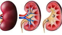 కిడ్నీలో రాళ్లు ఏర్పడడానికి కారణాలు ఇవే.. లక్షణాలు, నివారణ చిట్కాలు