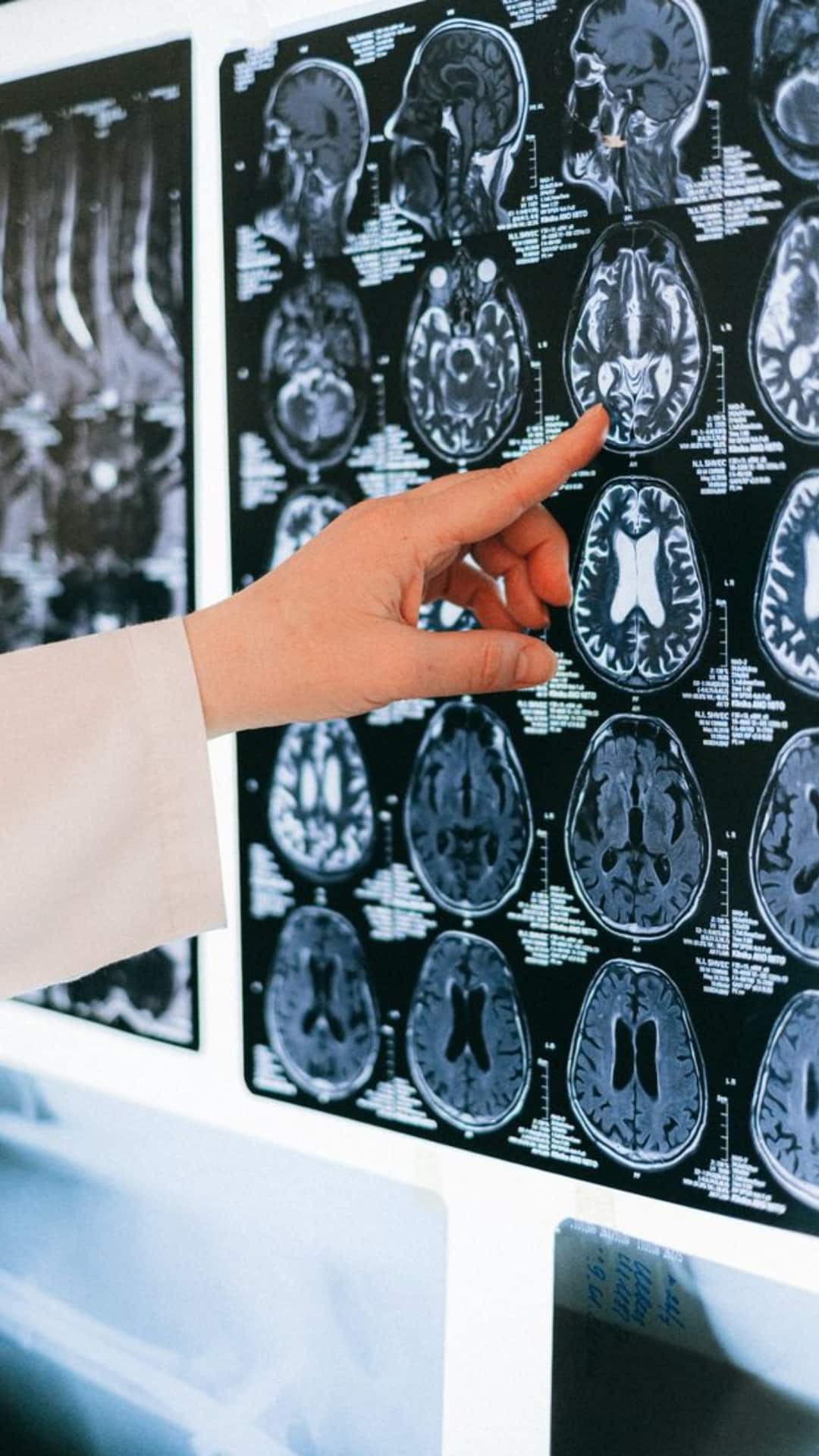 9 Brain-Boosting Foods That May Help Lower Tumour Risk Naturally