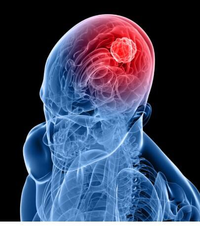 ਬ੍ਰੇਨ ਟਿਊਮਰ ਵੱਲ ਇਸ਼ਾਰਾ ਇਹ 6 ਸੰਕੇਤ ? ਨਜ਼ਰਅੰਦਾਜ਼ ਕਰਨਾ ਮੌਤ ਨੂੰ ਦਿੰਦਾ ਸੱਦਾ...