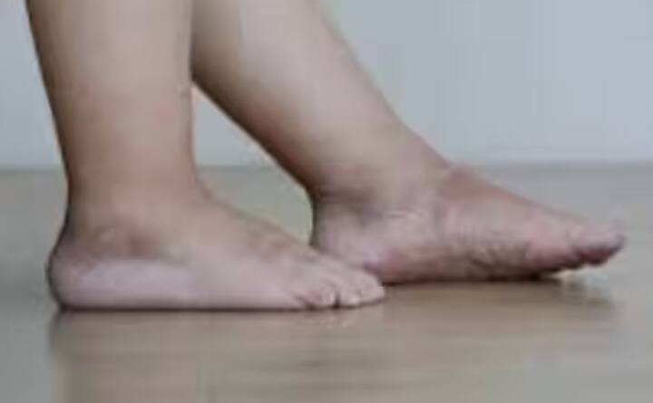 ਗਿੱਟਿਆਂ ਅਤੇ ਪੈਰਾਂ ਵਿੱਚ ਸੁੱਜਣਾ: ਜਦੋਂ ਤੁਸੀਂ ਨੀਂਦ ਤੋਂ ਬਾਅਦ ਉੱਠਦੇ ਹੋ ਅਤੇ ਦੇਖਦੇ ਹੋ ਕਿ ਤੁਹਾਡੇ ਪੈਰ ਸੁੱਜੇ ਹੋਏ ਹਨ, ਤਾਂ ਸੁਚੇਤ ਰਹੋ। ਜਦੋਂ ਗੁਰਦੇ ਪਾਣੀ ਨੂੰ ਸਹੀ ਢੰਗ ਨਾਲ ਕੱਢਣ ਵਿੱਚ ਅਸਮਰੱਥ ਹੁੰਦੇ ਹਨ, ਤਾਂ ਸਰੀਰ ਵਿੱਚ ਤਰਲ ਪਦਾਰਥ ਇਕੱਠਾ ਹੋਣਾ ਸ਼ੁਰੂ ਹੋ ਜਾਂਦਾ ਹੈ, ਖਾਸ ਕਰਕੇ ਲੱਤਾਂ ਵਿੱਚ।