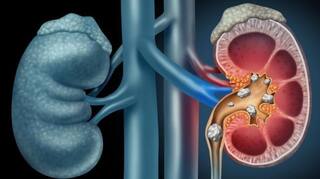Kidney Stone Causes: ਸਾਵਧਾਨ! ਸਰਜਰੀ ਤੋਂ ਬਾਅਦ ਦੁਬਾਰਾ ਪੱਥਰੀ ਬਣਨ ਦਾ ਕਿਉਂ ਵੱਧਦਾ ਖ਼ਤਰਾ ? ਜਾਣੋ ਕਿਹੜੀ ਗਲਤੀ ਬਣਦੀ ਖਤਰਨਾਕ?